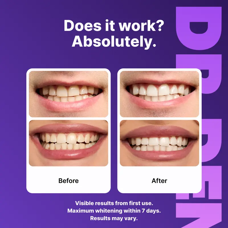 Valentine’s Sale 48%OFF💋Purple Teeth Whitening Strips - 7/21 Whitening Sessions